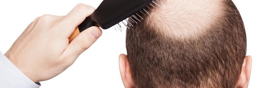 выпадение волос у мужчин причины и лечение